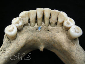 Lapis lazuli pigment imbedded in lower jaw.